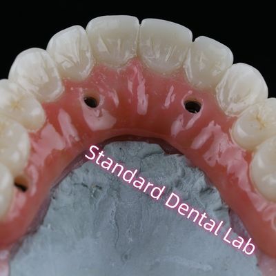 comprar Implantación dental corona PFZ porcelana con capas de tornillo de zirconia retenido con goma rosada fabricación en línea