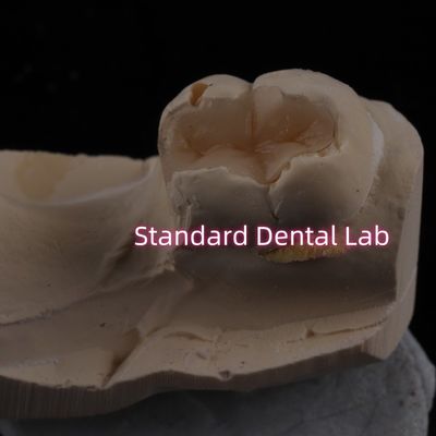 comprar Enlaces dentales de porcelana fundida Enlaces de recubrimiento Zirconia Emax Alta estética fabricación en línea