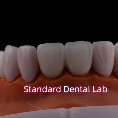 comprar Carillas laminadas de zirconia Emax Tranlucentes Carillas dentales de porcelana Químicamente verystable fabricación en línea