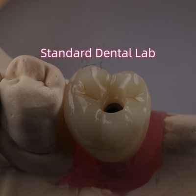 comprar Coroa de implante dental con tornillo retenido PFZ de porcelana con capas de zirconia fabricación en línea