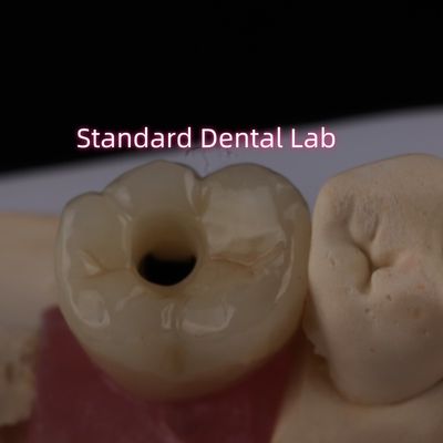 comprar Implante posterior de la corona Bruxier con tornillo de zirconia sólida retenido fabricación en línea
