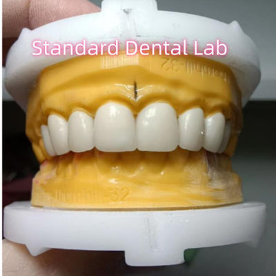 comprar Veneceras de corona de zirconia de Ivoclar de alta translucidez fabricación en línea