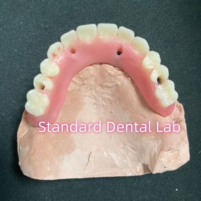 comprar Implante parcial de acrílico sobre la dentadura postiza barra de ticianos dentadura completa dientes instalados tornillo retenido fabricación en línea