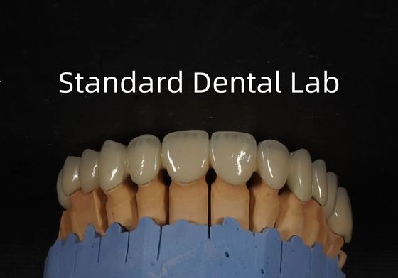 comprar China Laboratorio Dental Corona de metal cerámica PFM Corona de alta estética fabricación en línea