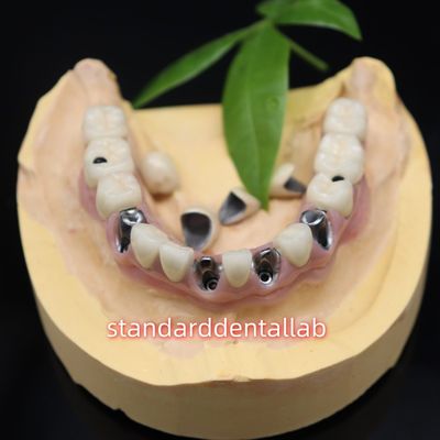 comprar Implantes dentales con tornillo retenido Coronas metálicas cerámicas Puente Malo fabricación en línea