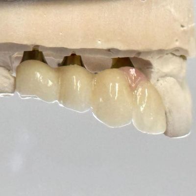 comprar Implante de tornillo retenido de porcelana de cemento de zirconia Forma de cabeza hexagonal para estética de ajuste personalizado fabricación en línea