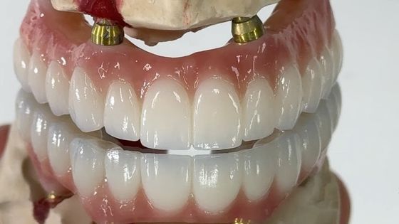 comprar Dental Todo sobre X Implante PFM Corona Titanio Fijación de la prótesis híbrida fabricación en línea