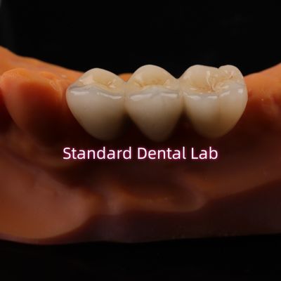 comprar Coronas digitales de laboratorio dental CAD CAM de zirconía translúcida en capas fabricación en línea