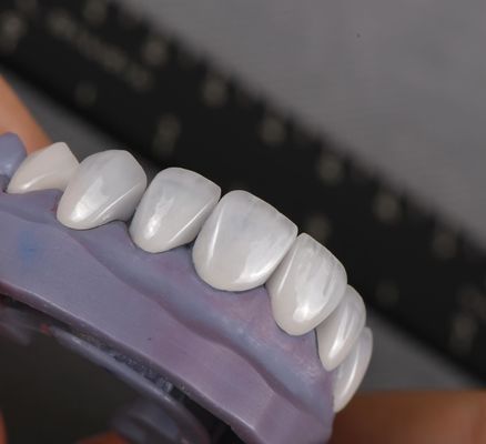 comprar Emax Veneers de aspecto natural Corona Biocompatibilidad Sombra de blanqueamiento con una preparación mínima fabricación en línea