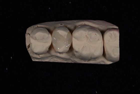 comprar Fortaleza Emax Carillas de cerámica corona con excelente resistencia a las manchas / biocompatibilidad fabricación en línea