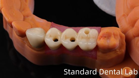 comprar Implante dental de zirconio profesional corona de titanio CAD CAM corona de zirconio China laboratorio dental fabricación en línea