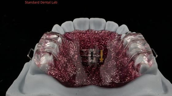 comprar Expansión y desestabilización de los dientes Expansión de ajuste en la boca Ortodoncista Expansión del paladar fabricación en línea