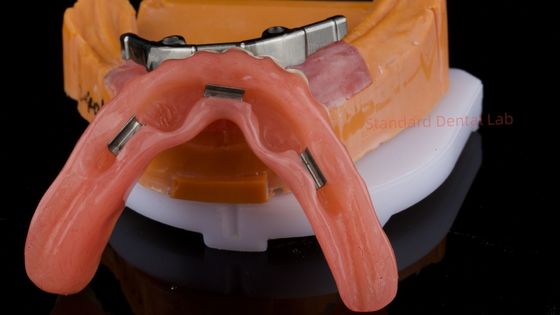 comprar Dentadura con implantes dentales digitales Ivoclar Dentadura completa con implantes de acrílico Dentadura de titanio Dentadura con implantes de titanio fabricación en línea