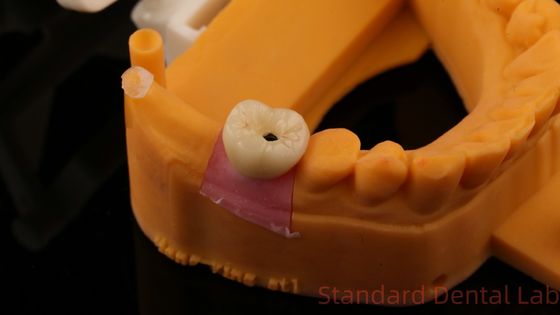 comprar Parafusos para implantes dentales con corona retenida PFZ porcelana con capas de zirconia con modelo de impresión 3D fabricación en línea