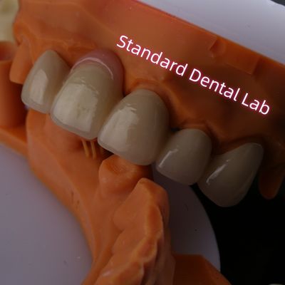 Porcelana PFZ altamente biocompatible con capas de zirconia con goma rosada