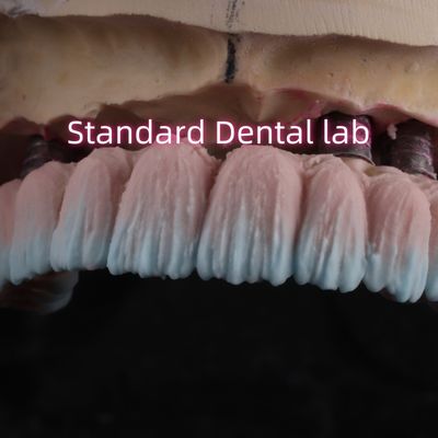 Torsión de puente de implante de zirconia retenida con porcelana de goma rosa