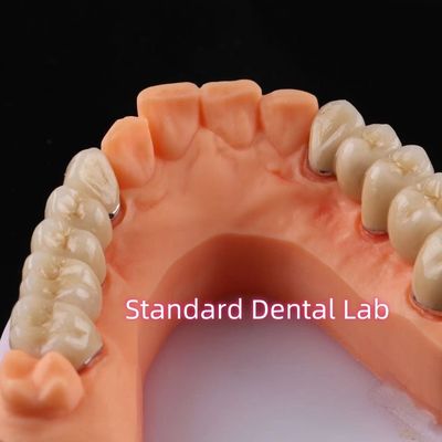Dental de puente digital de porcelana de metales no preciosos
