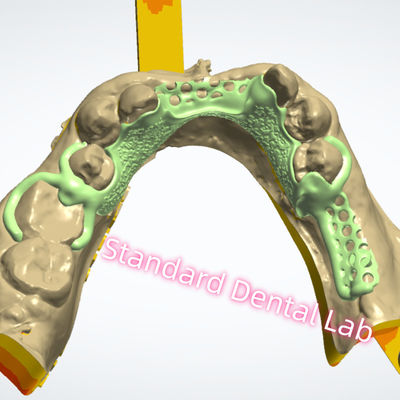 Diseño de marco de metal Impresión láser Dentadura parcial de cromo fundido Ni ser libre