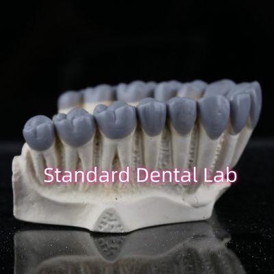 SDL Dental Lab Diagnóstico Digital Cera Puente de Corona