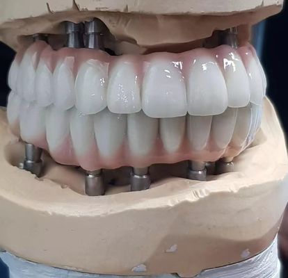 Cementos de tornillo para implantes de zirconia de fabricación precisa retenidos para dientes de aspecto natural