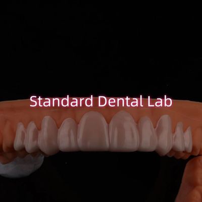 Aplicación de carillas para la sonrisa para la decoloración de los dientes