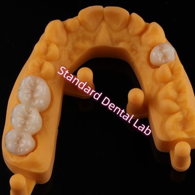 Coronado todos los dientes estéticos de cerámica de porcelana de zirconia Ivoclar OEM