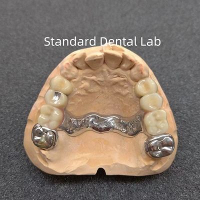 Dentista de precisión extraíble Dentadura parcial Profesional estable