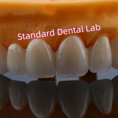 Restauración de la parte delantera de las coronas de zirconia para dientes perdidos
