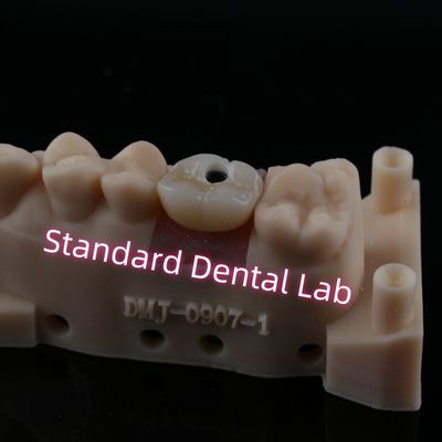 Coroa de implante de abutment personalizado de contorno completo de tornillo de zirconia retenido