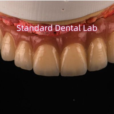PFM Digital Coronas de porcelana de metales no preciosos Puente de alta estética natural