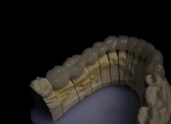 Porcelana en capas de zirconio fundido