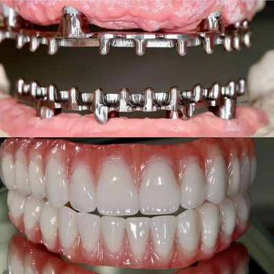 Dental Hybird Malo Implante Puente Profesional de ajuste perfecto Certificado por la FDA