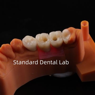 Puente de implantes dentales de porcelana de zirconia alta estética profesional