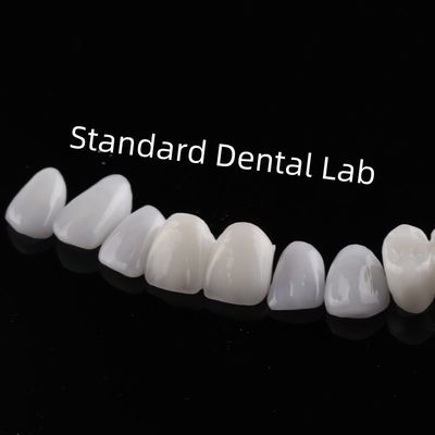 Dentes de alta estética con carillas laminadas Emax Translucidez incisional