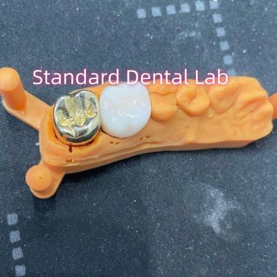 Corona de aleación de metal amarillo no precioso con corona de zirconio