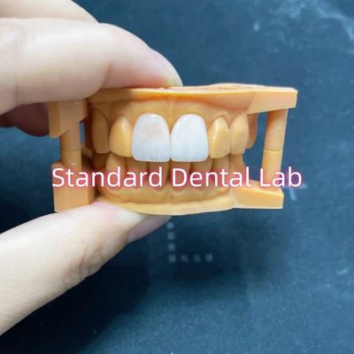 Alta estabilidad del color Ivoclar Emax carillas laminadas Alta translucidez