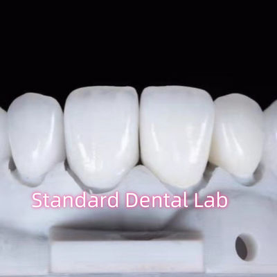 Restauración de apariencia natural con ayuda dental de zirconia corona dental