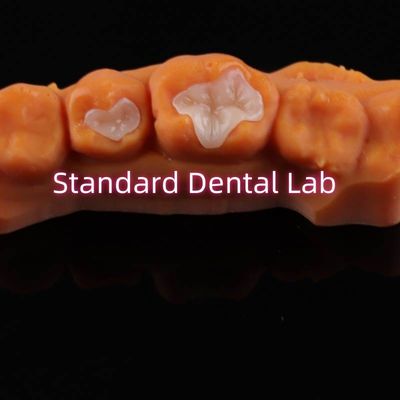 Enlaces de porcelana dental enlaces de recubrimiento zirconia Emax compuesto para caries dental