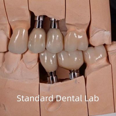 Coroa de implante de zirconia con tornillo estética de aspecto natural