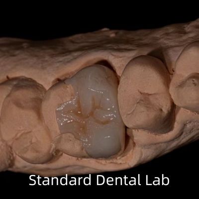 Translucidez Emax Zirconia Dental Inlay Onlay Corona para restaurar la forma natural de la cavidad
