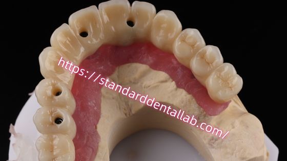 Puente de implante de tornillo de zirconia de múltiples capas Biocompatible en estructura metálica