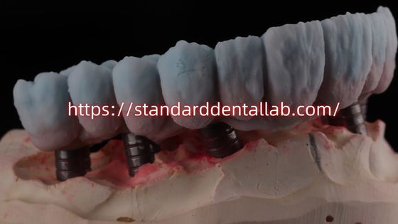 Puente de zircónia con apoyo de implantes con abutment de titanio de alta estética