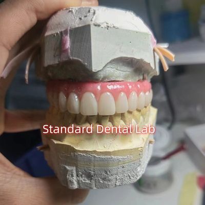 Vértice retenido de titanio PMMA puente dental corona temporal