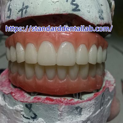 Implante dental corona temporal puente PMMA con porcelana rosa