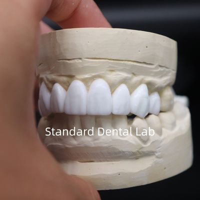 Coronas dentales de diagnóstico de cera de alta estética de laboratorio dental de China