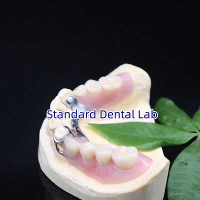 Cuadro de dentadura parcial de acrílico metálico Alta estética laboratorio dental SDL