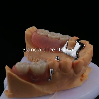 Cuadro de dentadura parcial de aleación de metal 3 forma Exocad Impresión láser de fundición inferior de acabado parcial