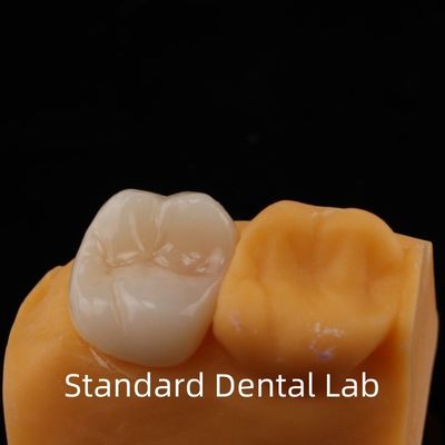 5 años de garantía de contorno completo corona de zircónia para dientes molares porcelana Noritake hecha en un laboratorio dental de confianza
