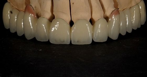 Buen ajuste Buena estética Corona de zirconia de varias capas Puente de porcelana de zirconia