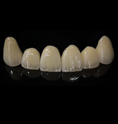 Confortable corona de zirconia con buen ajuste y estética de precisión